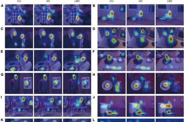 AI-ba<em></em>sed diagnostic tool differentiates dementia diseases by analysis of eye movement patterns